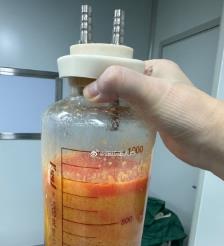 无为水动力吸脂手术要做多久？